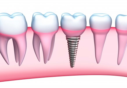 German Arzate DDS – What does an Implantologist know?